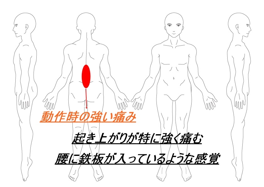 ぎっくり腰