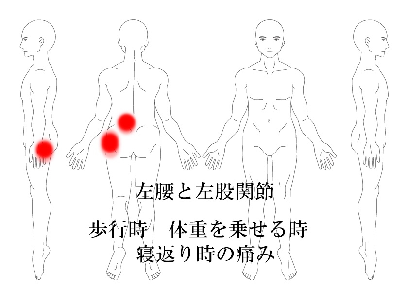 腰痛　股関節痛