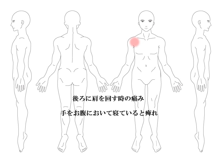 肩の痛み