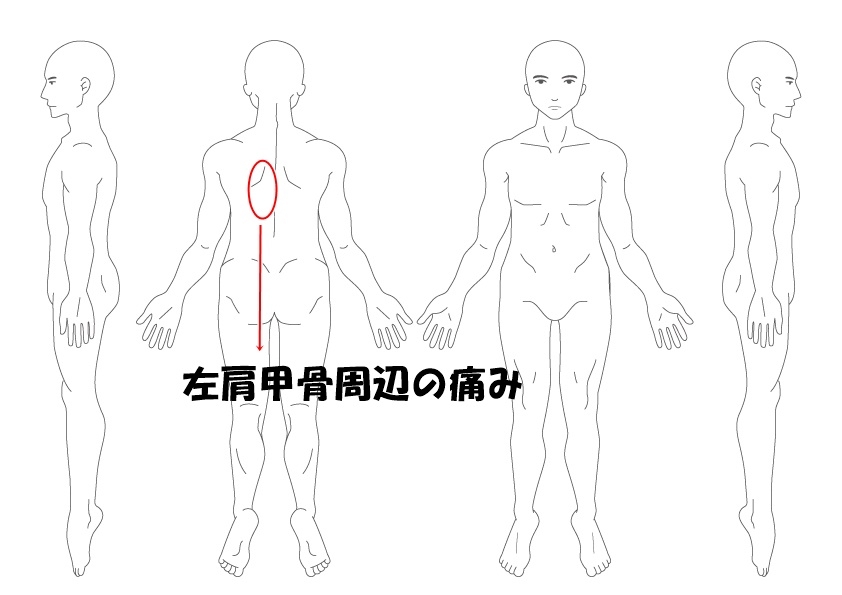 肩甲骨周辺の痛み 症例 沖縄の那覇にある當山鍼灸院が 腰や肩 背中の痛みを針治療で改善