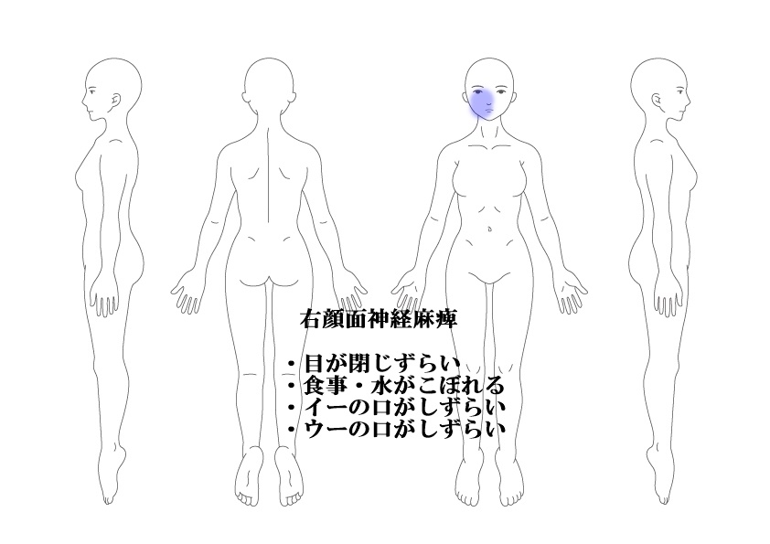 右顔面神経麻痺