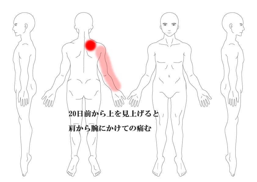 肩の痛み