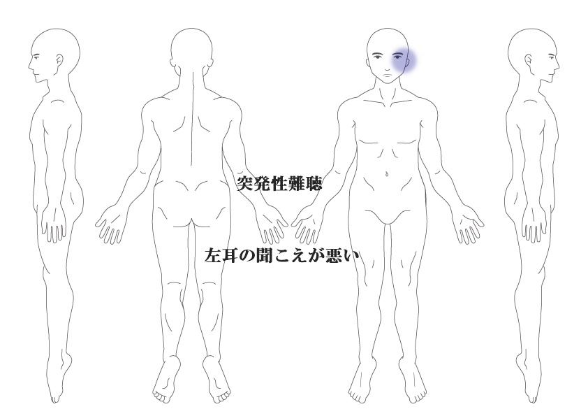 突発性難聴