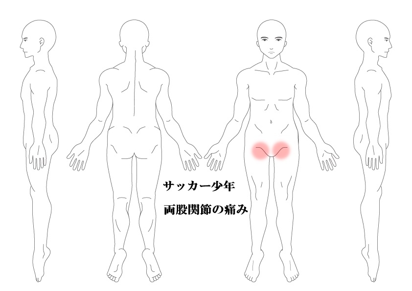 股関節の痛み