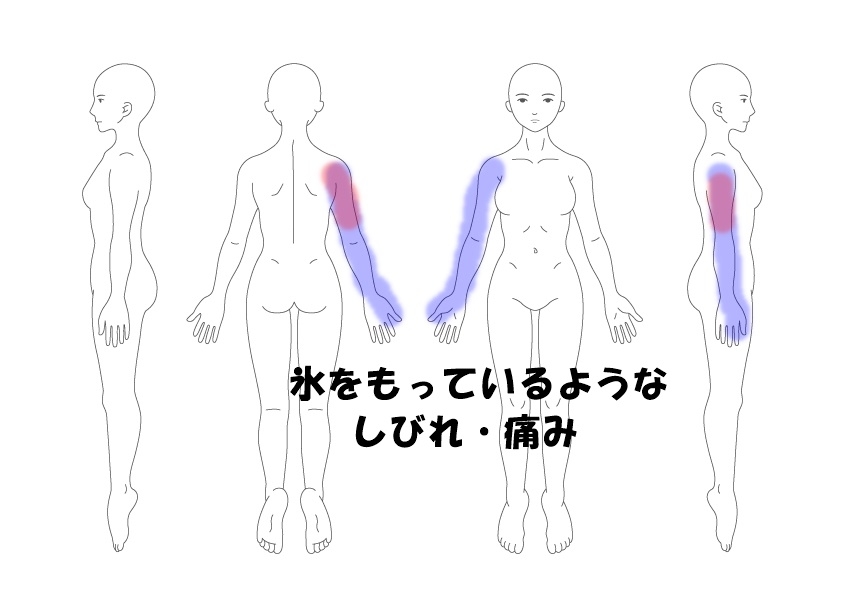 しびれ 腕の痛み 症例 | 沖縄の那覇にある當山鍼灸院が、腰や肩、背中の痛みを針治療で改善