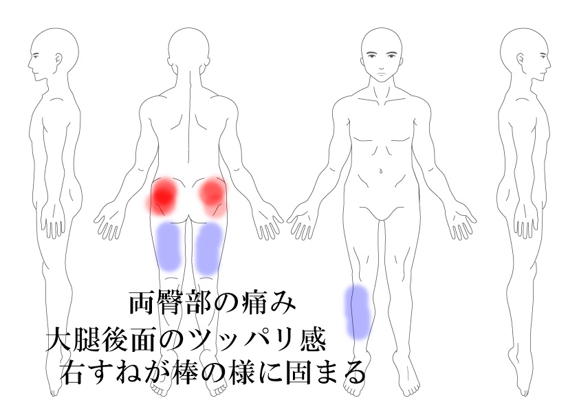 臀部の痛み