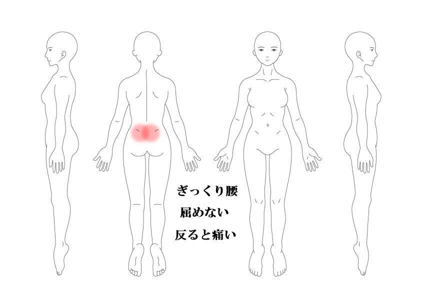 ぎっくり腰