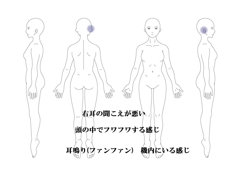 突発性難聴